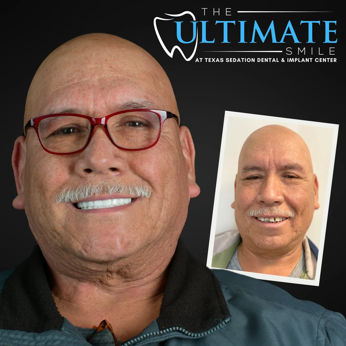 Patient smile after dental implant treatment