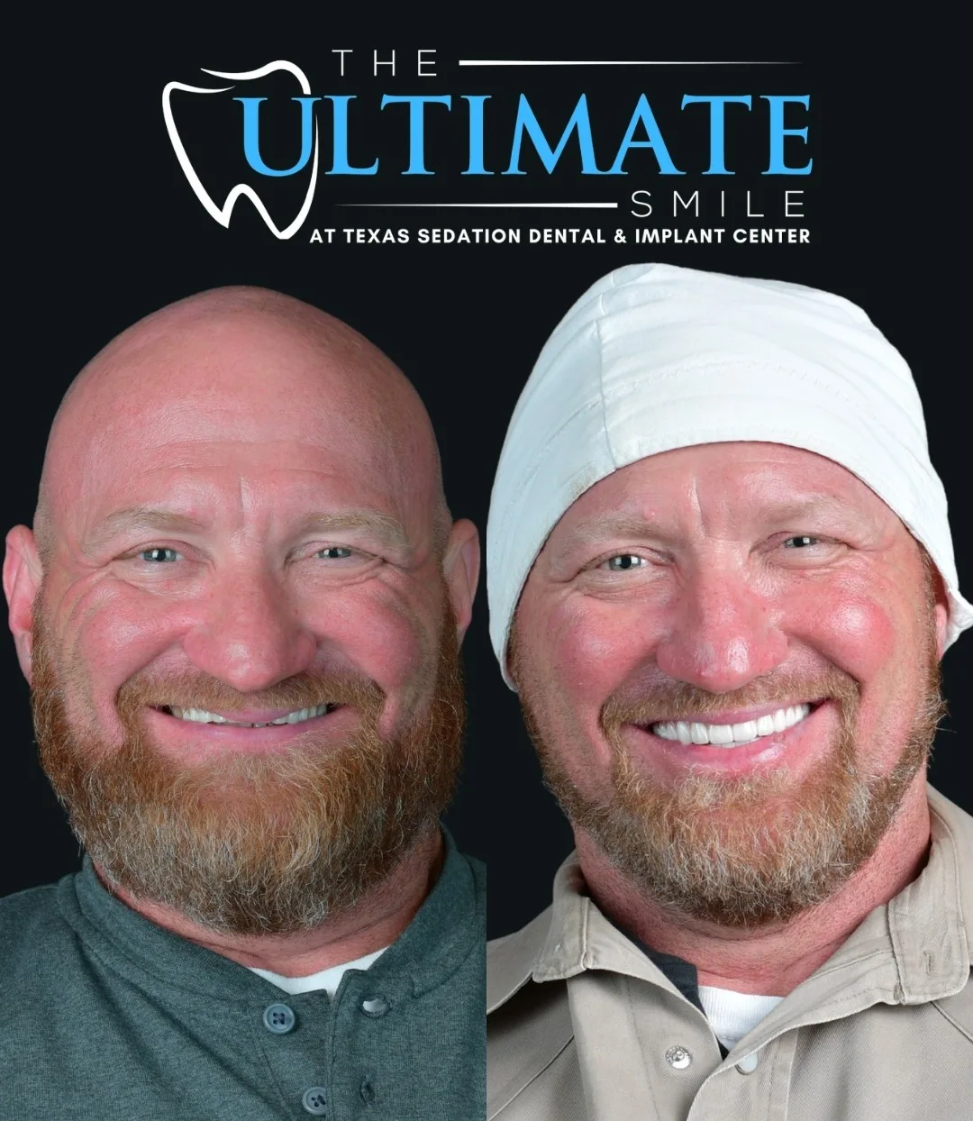 Before and after dental implant smile transformation, Haughton area patient