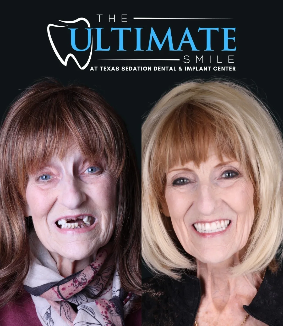 Before and after dental implant smile transformation, Haughton area patient