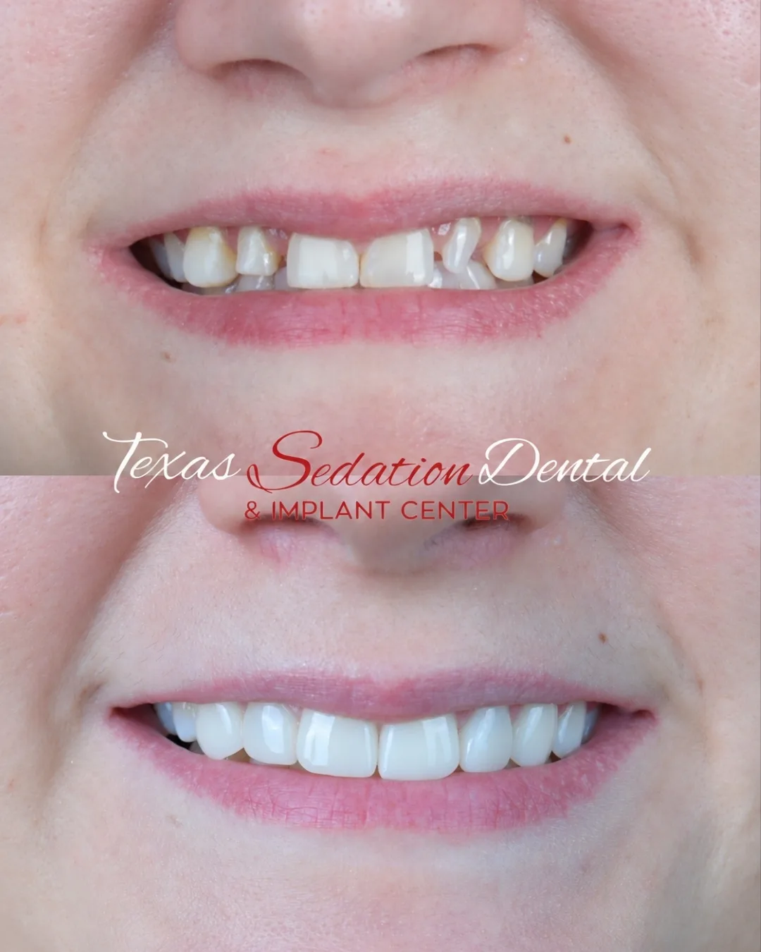 Before and after dental crowns, real patient of Texas Sedation Dental & Implant Center near Tyler