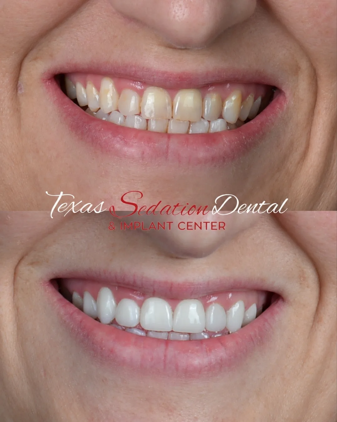 Before and after dental crowns, real patient of Texas Sedation Dental & Implant Center near Tyler