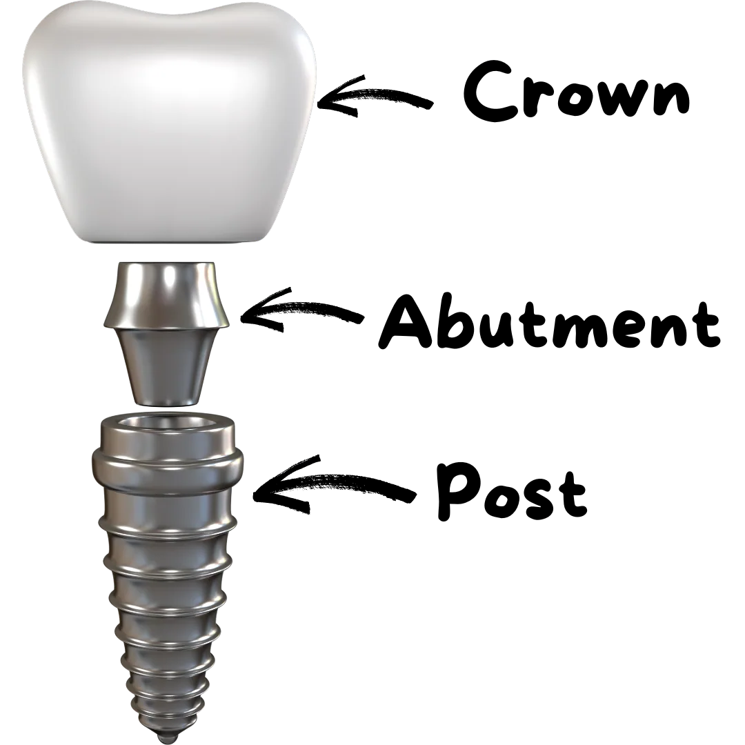 Dental implant with crown and abutment components