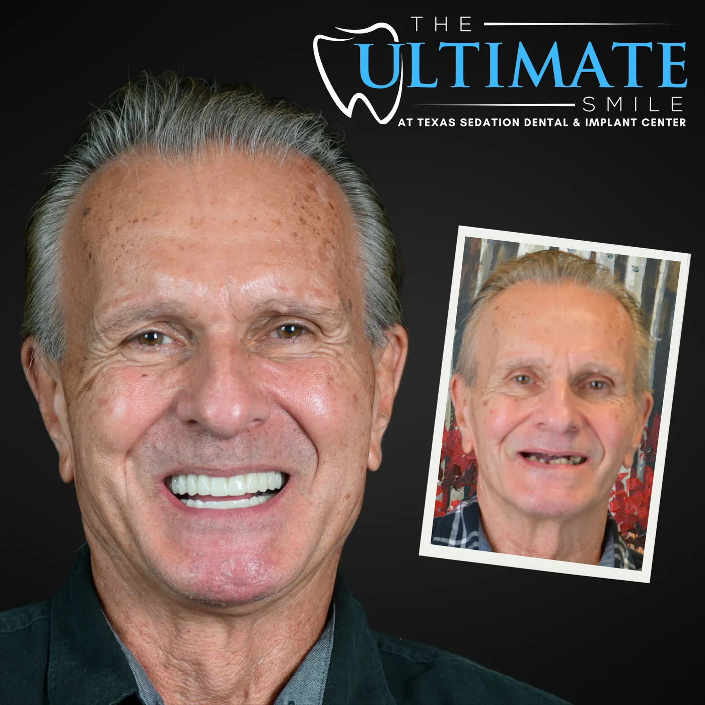 Patient before and after smile transformation
