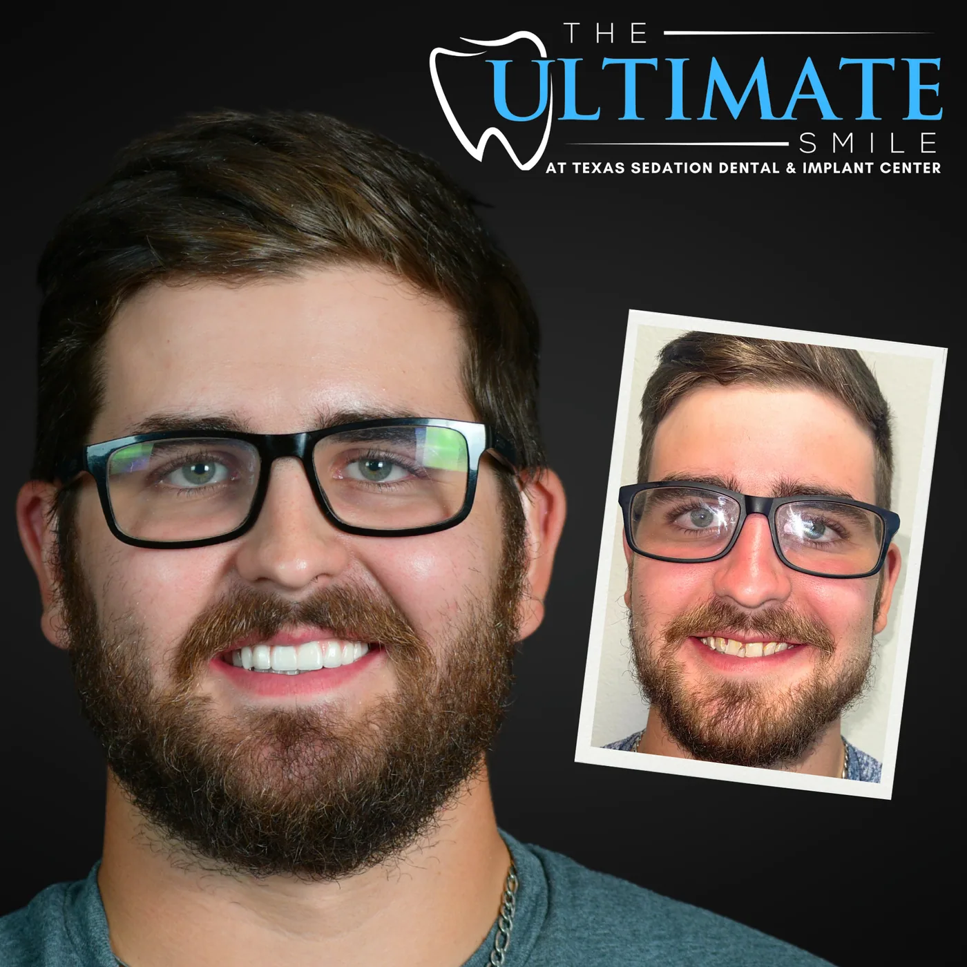 Patient before and after smile transformation