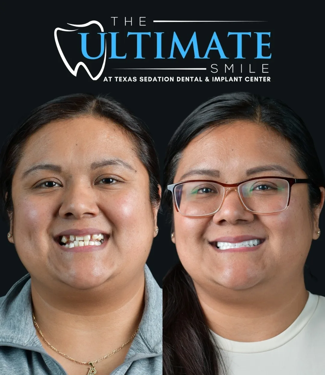 Woman before dentures with gapped, damaged teeth, and after with a bright new smile