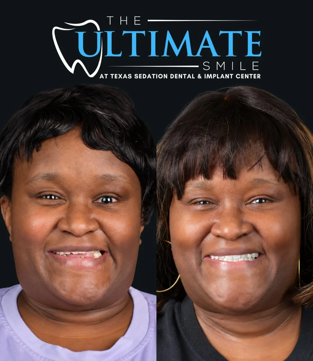 Woman before dentures with missing teeth, and after with a complete new smile