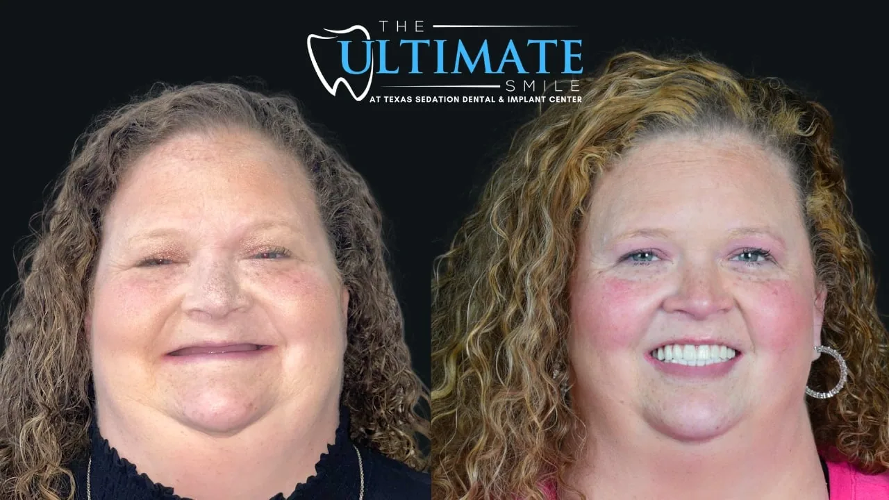 Real Texas Sedation Dental patient, before and after smile transformation