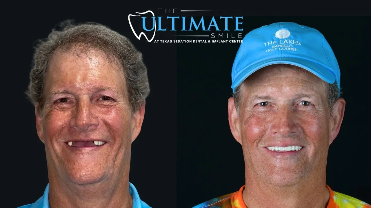 Real Texas Sedation Dental patient, before and after smile transformation