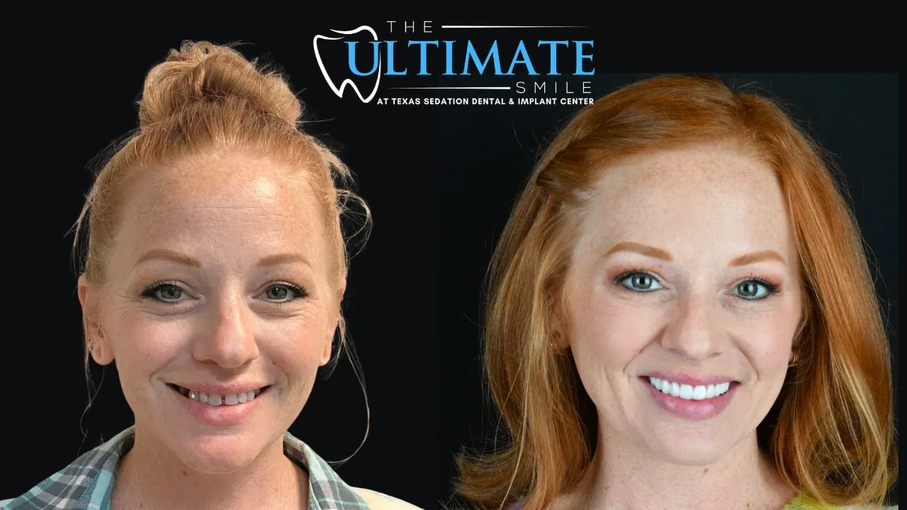 Real Texas Sedation Dental patient, before and after smile transformation