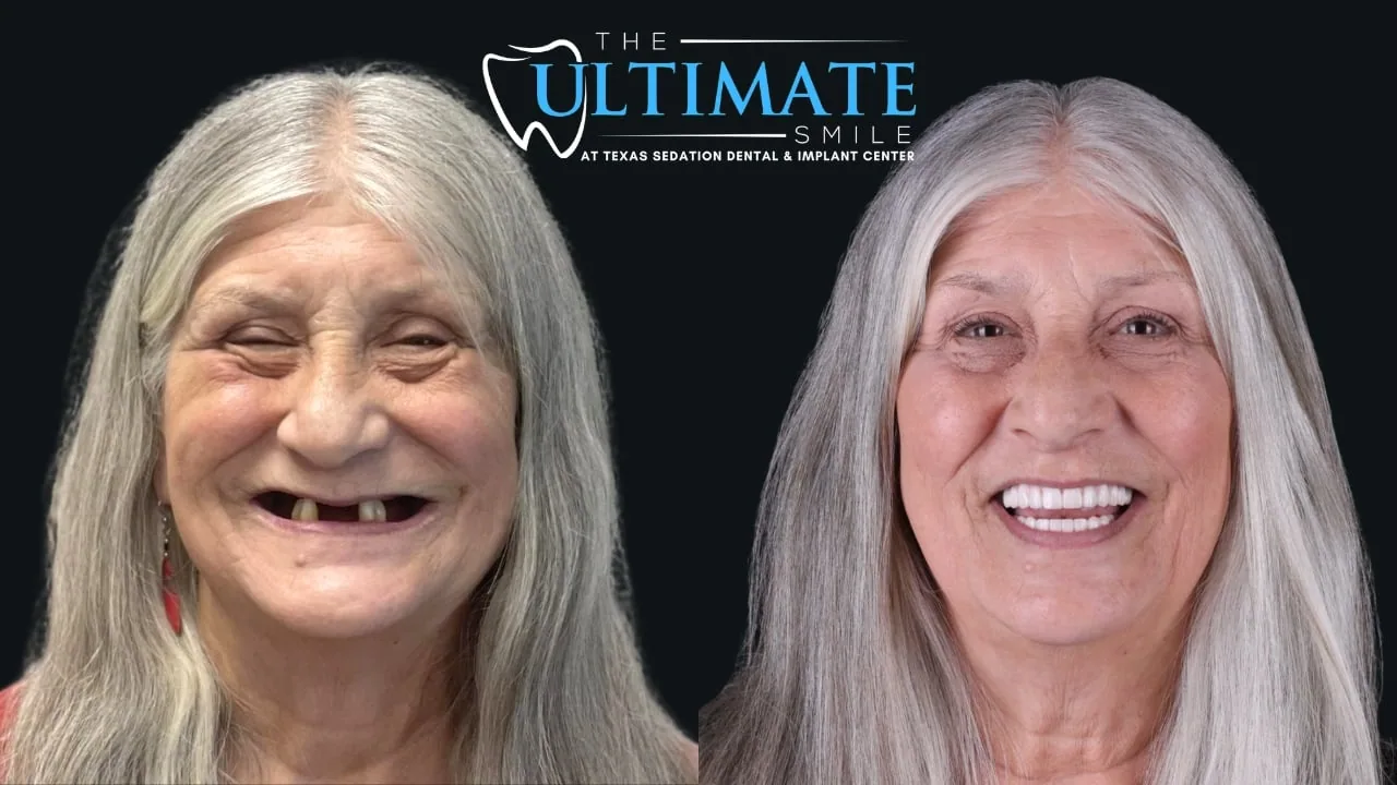 Real Texas Sedation Dental patient, before and after smile transformation