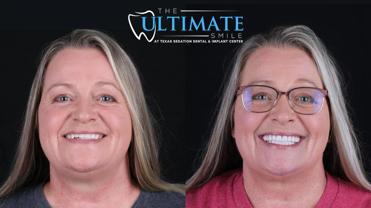 Real Texas Sedation Dental patient, before and after smile transformation