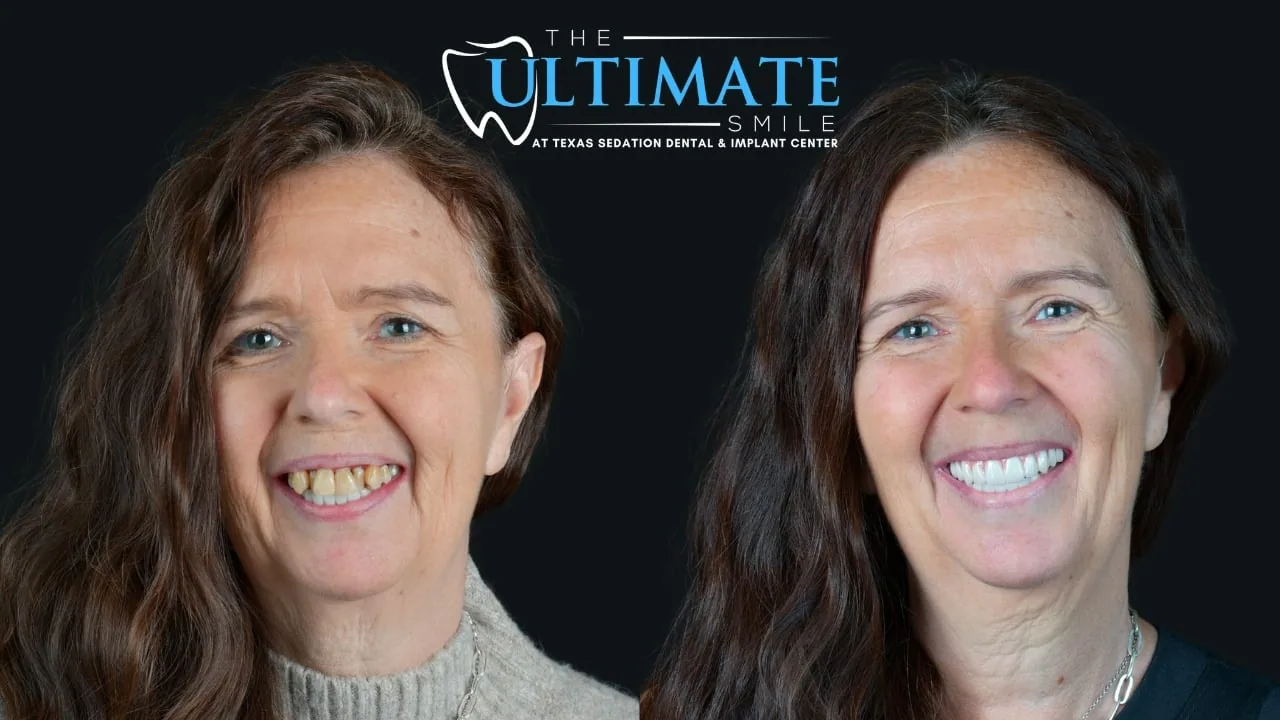 Real Texas Sedation Dental patient, before and after smile transformation