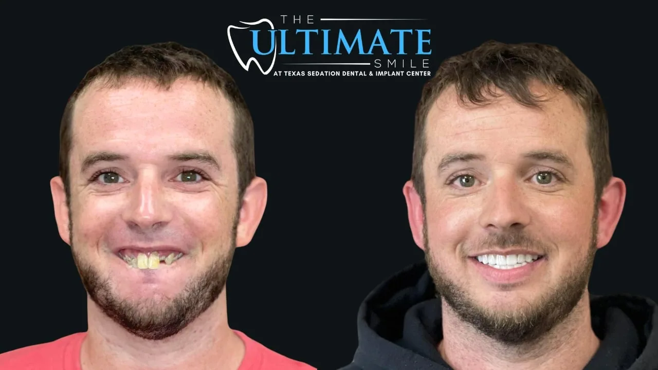 Real Texas Sedation Dental patient, before and after smile transformation