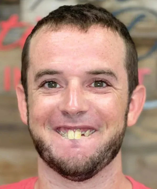 Before: original full-face photo with worn front teeth
