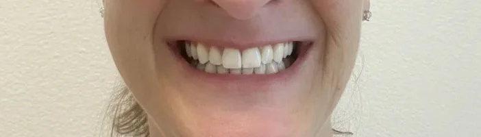 After: AI-restored smile preview
