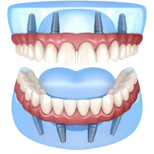 Diagram of full-arch implant placement showing correct implant positioning