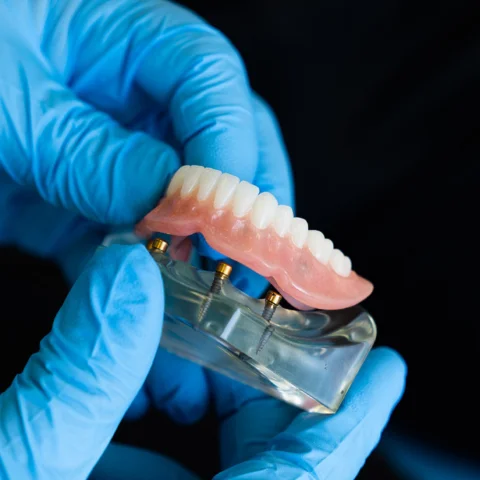 Gloved hands holding implant supported denture model with visible titanium posts
