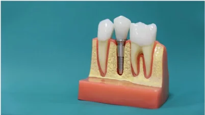 A dental implant model showing how an implant anchors into the jaw