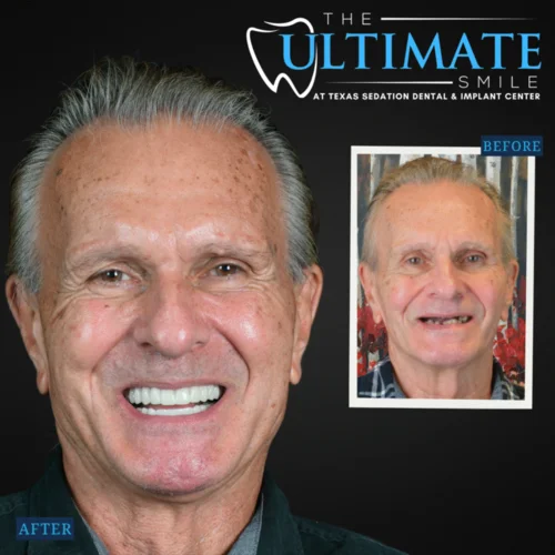 Dental smile makeover showing older male patient before and after teeth restoration