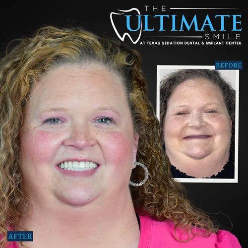 Dental smile makeover showing patient before and after teeth improvement