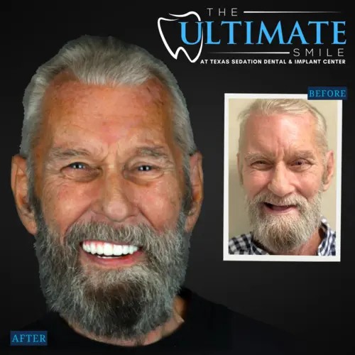 Smiling patient after dental treatment displayed beside smaller before smile comparison