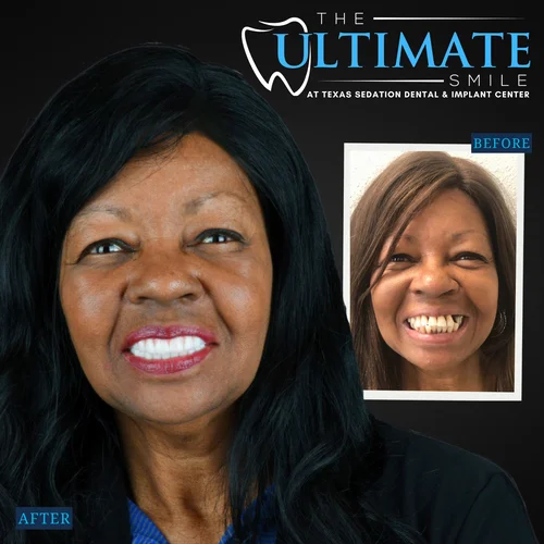 Dental smile makeover displaying before and after patient teeth results