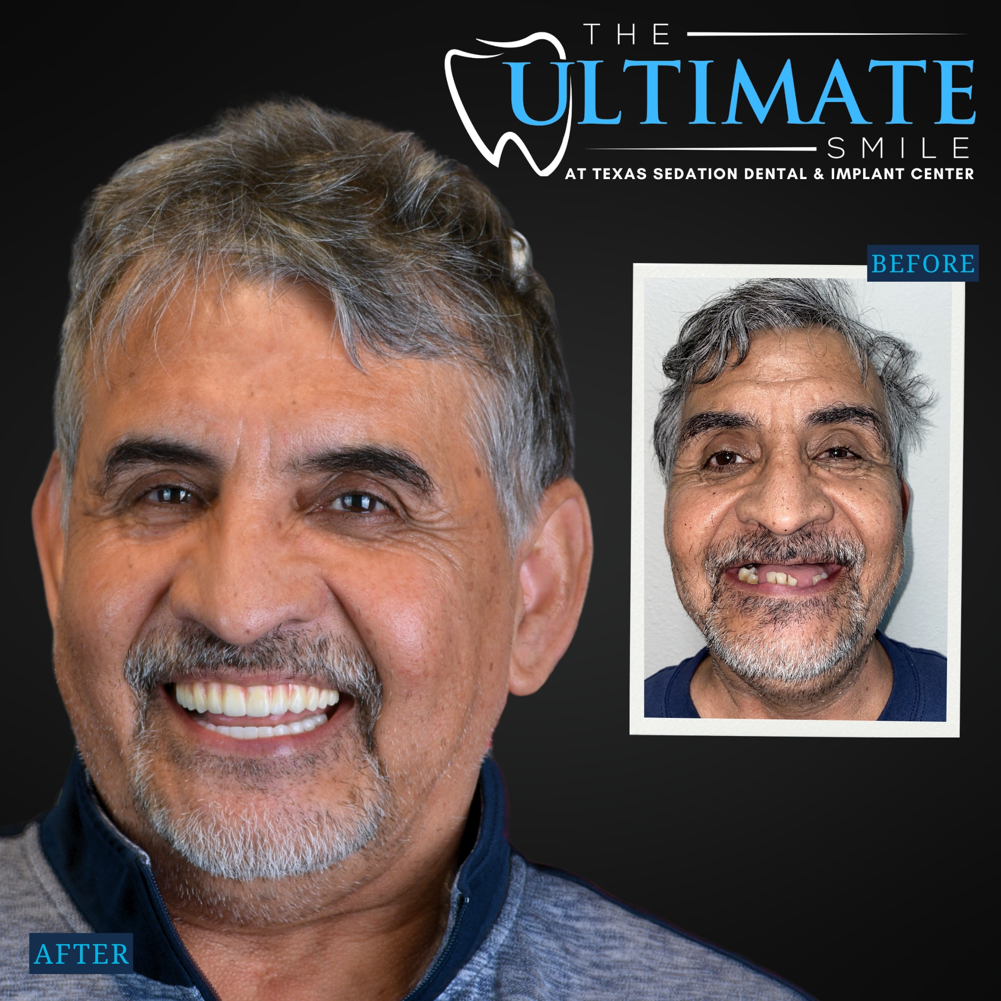 Smiling patient after dental treatment with inset before photo showing broken teeth