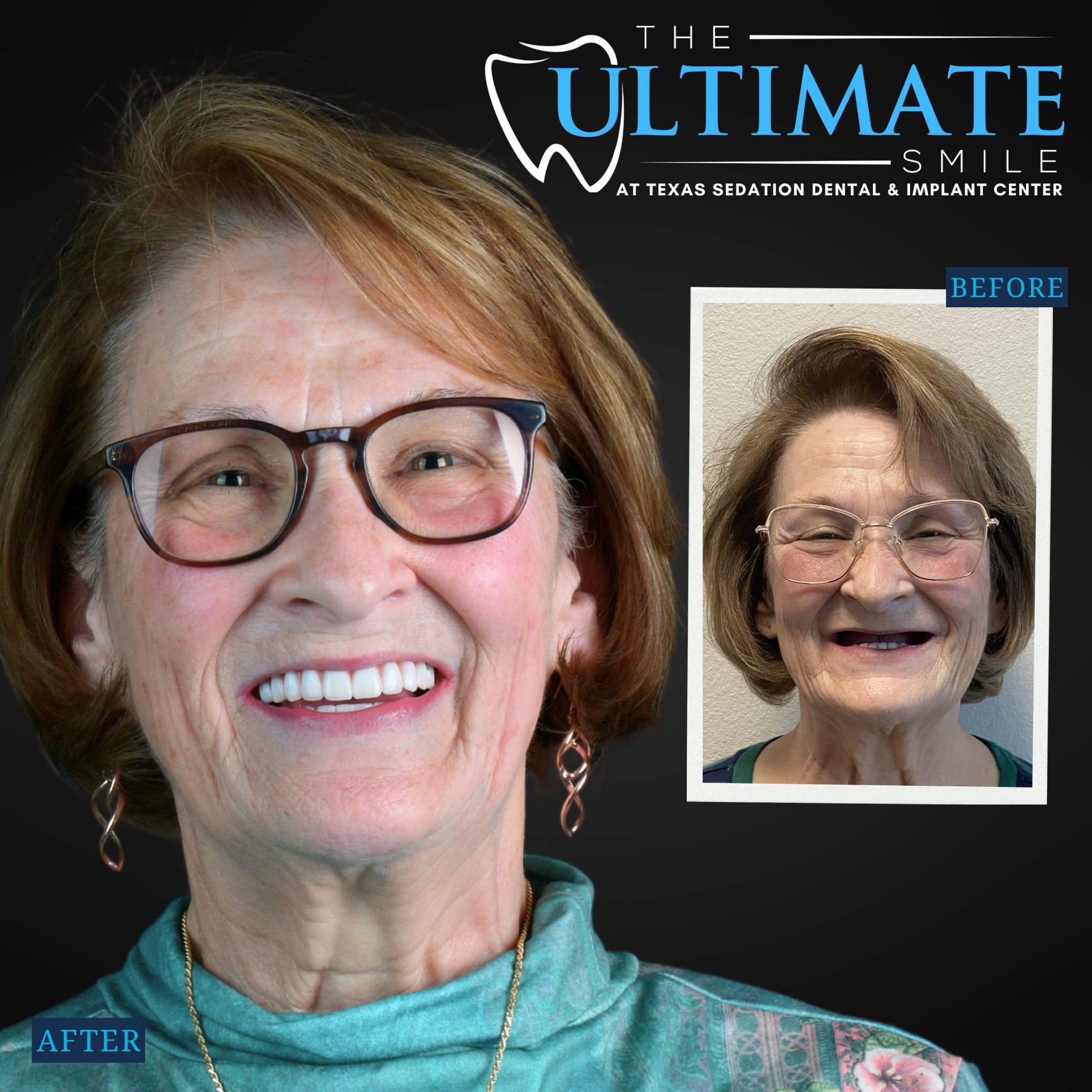 Smiling patient after dental treatment with inset before photo showing broken teeth