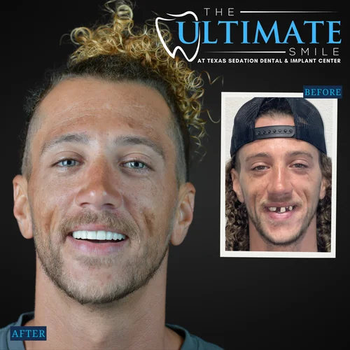 Dental smile makeover showing male patient before and after teeth restoration