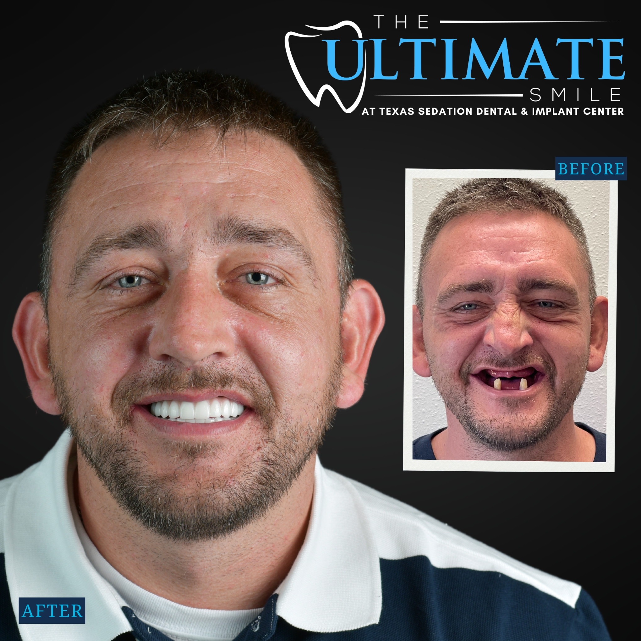 Smiling patient after dental treatment with inset before photo showing broken teeth