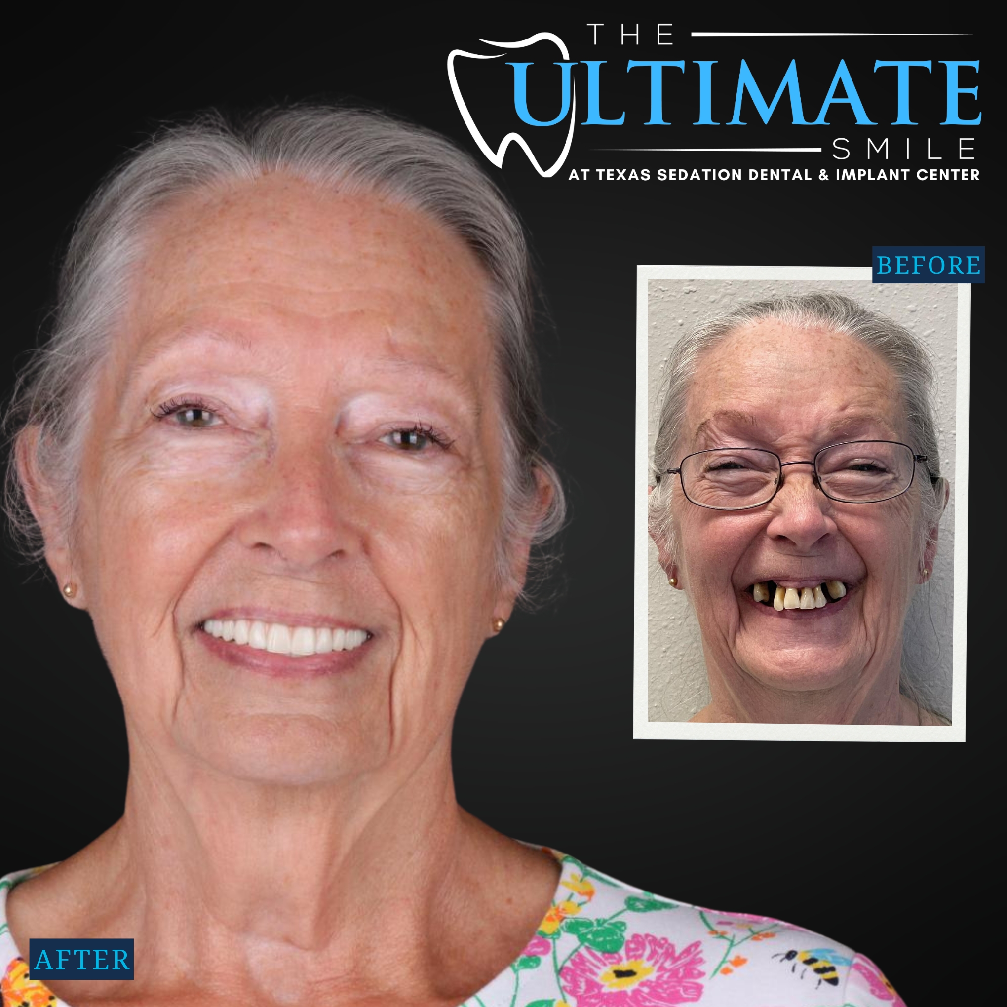 Smiling patient after dental treatment with inset before photo showing broken teeth
