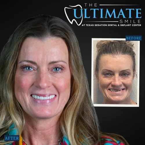 Dental smile makeover showing female patient before and after teeth restoration results
