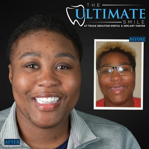 Dental smile makeover showing patient before and after teeth improvement