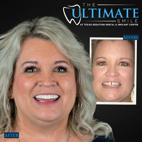 Dental smile makeover showing before and after patient teeth transformation