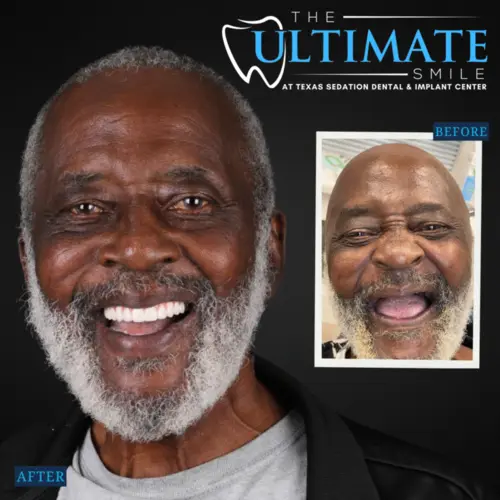 Dental smile makeover showing before and after patient facial expression and teeth improvement