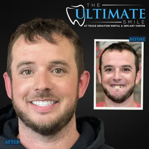 Patient smiling after dental treatment beside smaller before photo comparison