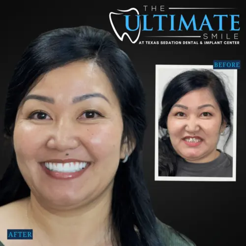 The Ultimate Smile AT Texas Sedation Dental & Implant Center