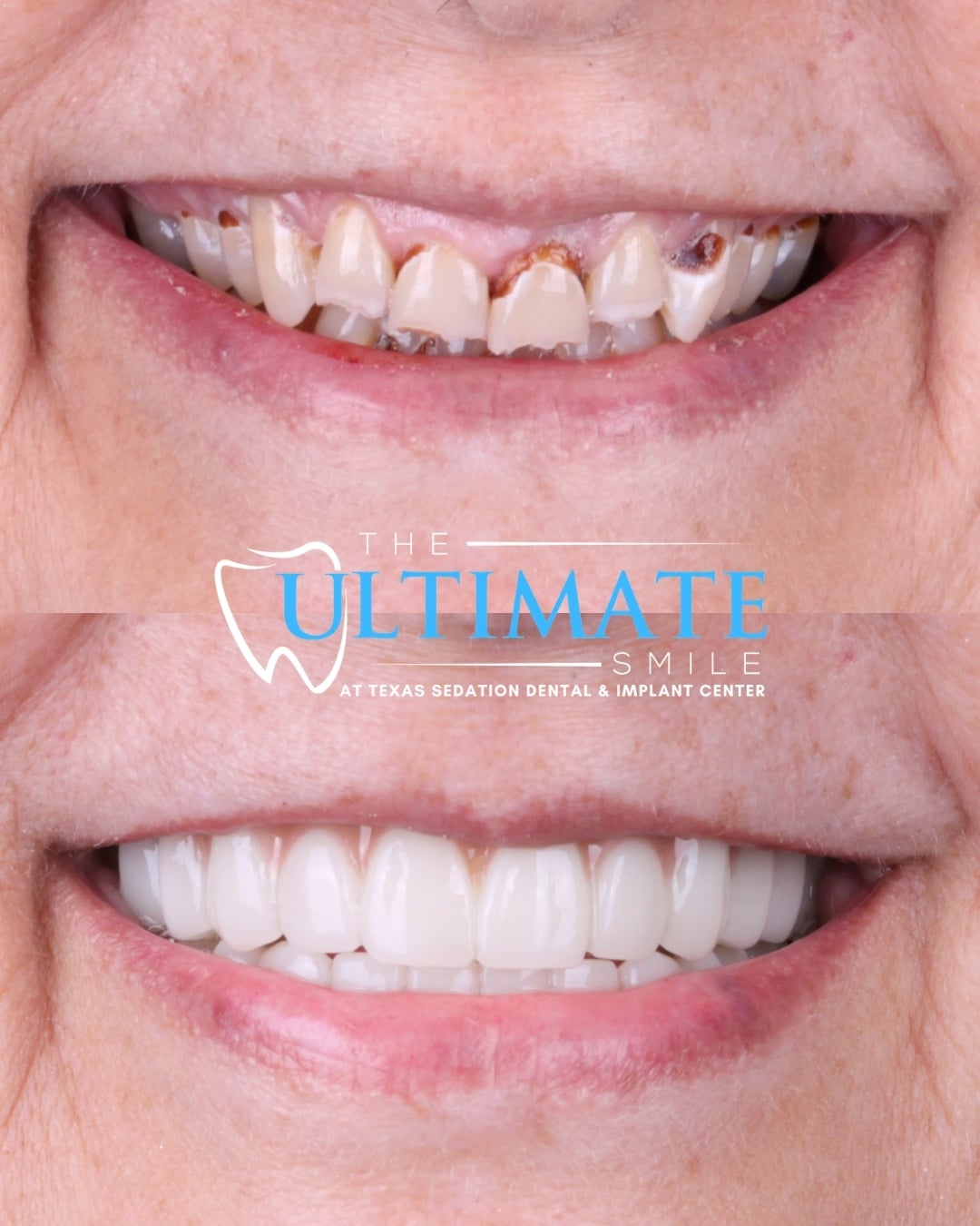 Upclose Smile B&As (1)